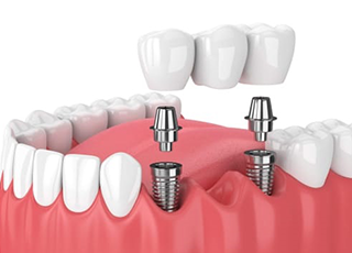 Implant