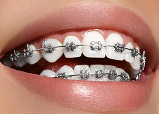 Orthodontic Treatment