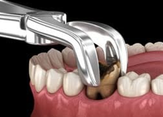 Painless Tooth Extraction