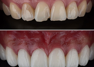 Smile Designing